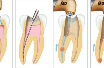 Лечение зубных каналов: особенности, как проводится
