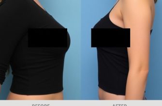 Новая грудь, новый взгляд: что нужно знать об увеличении груди и маммопластике